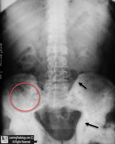 Paget Disease pelvis